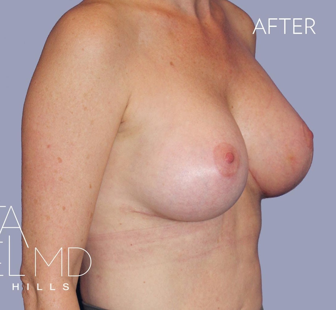 Breast Implant Replacement before and after - after