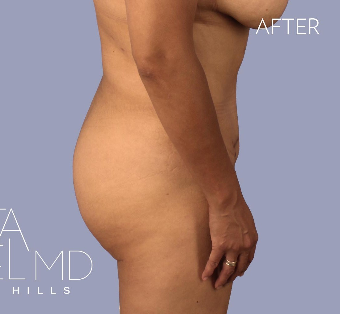 Brazilian Butt Lift before and after - after