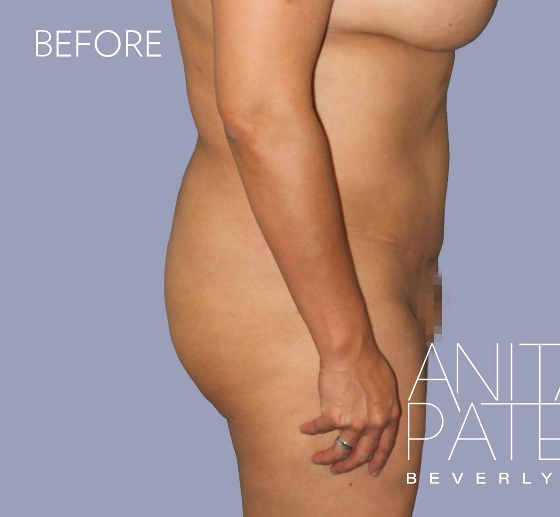 Brazilian Butt Lift before and after - before