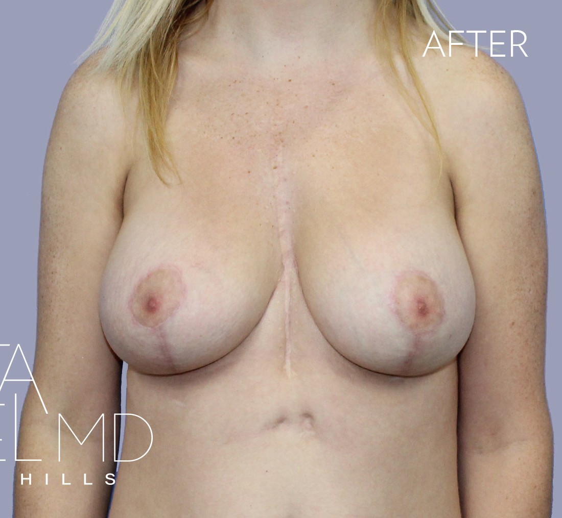 Breast Implant Replacement before and after - after