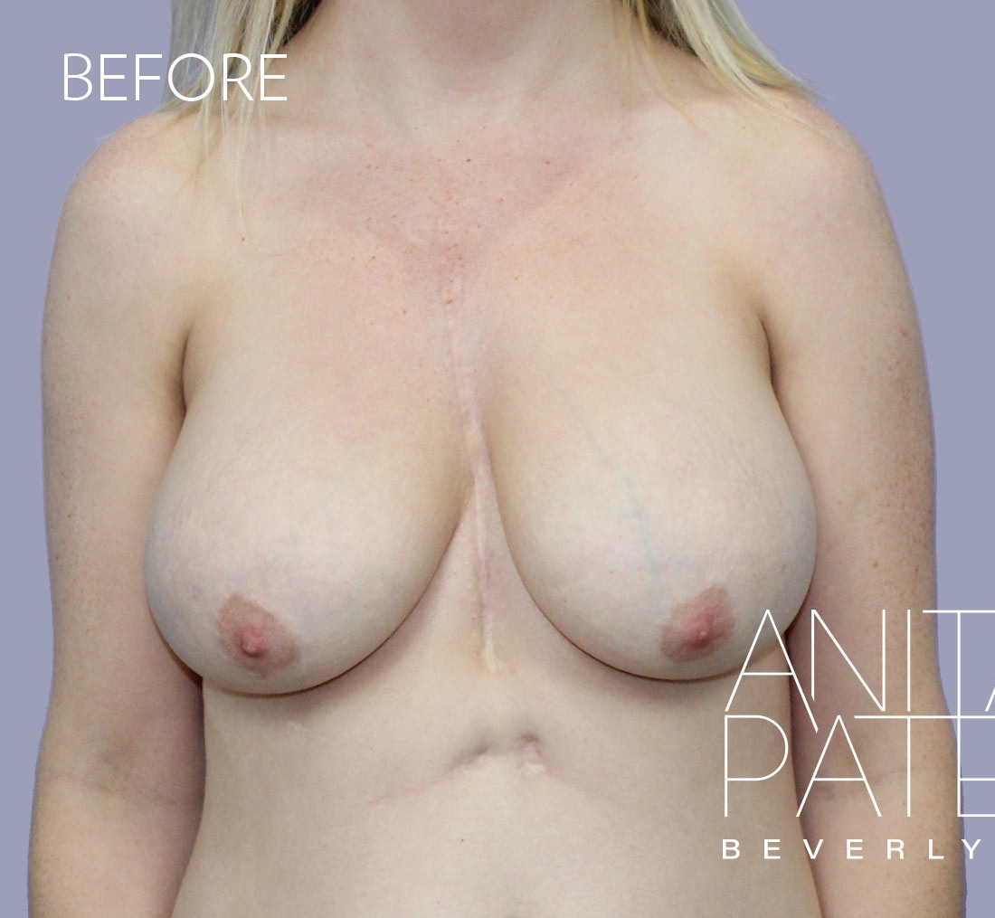 Breast Implant Replacement before and after - before