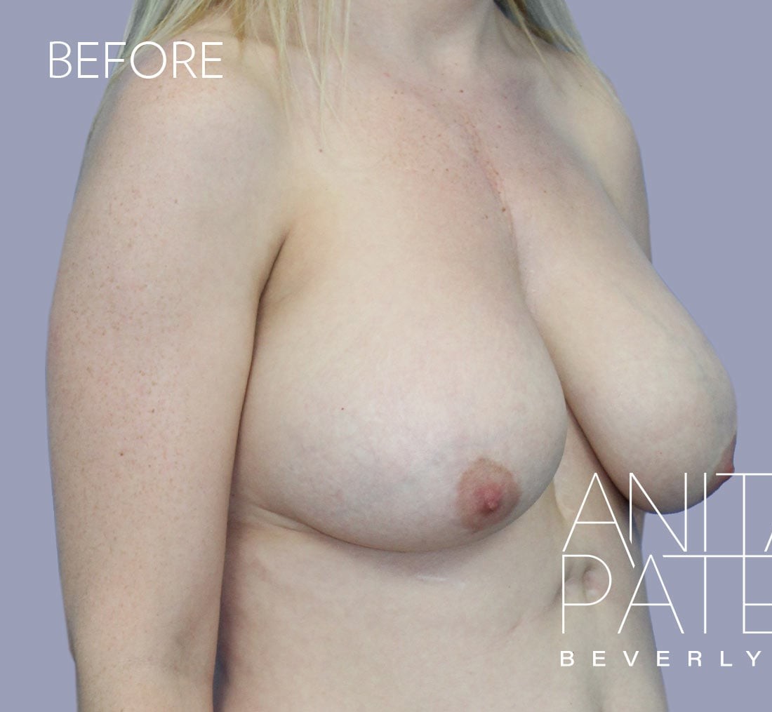 Breast Implant Replacement before and after - before