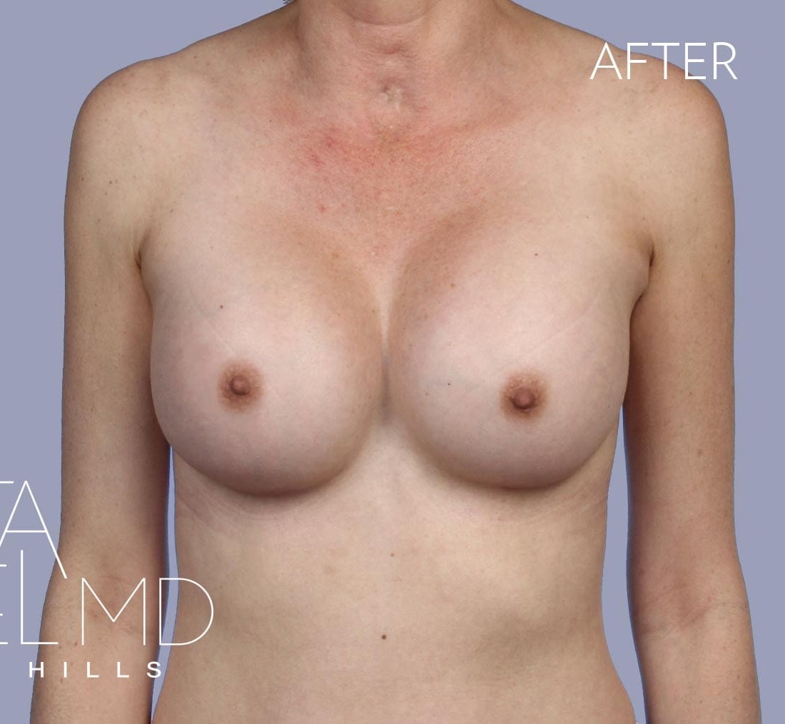 Breast Implant Replacement before and after - after