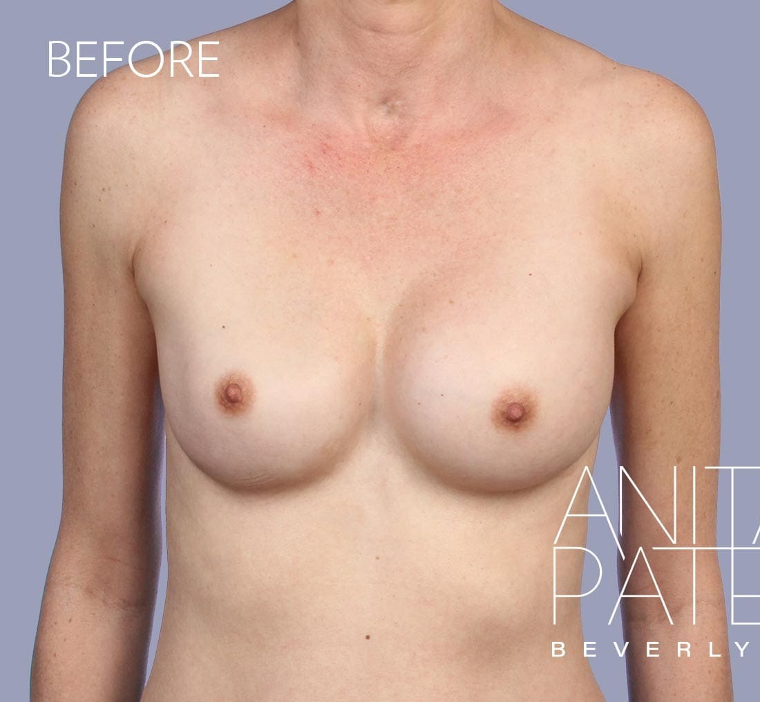 Breast Implant Replacement before and after - before