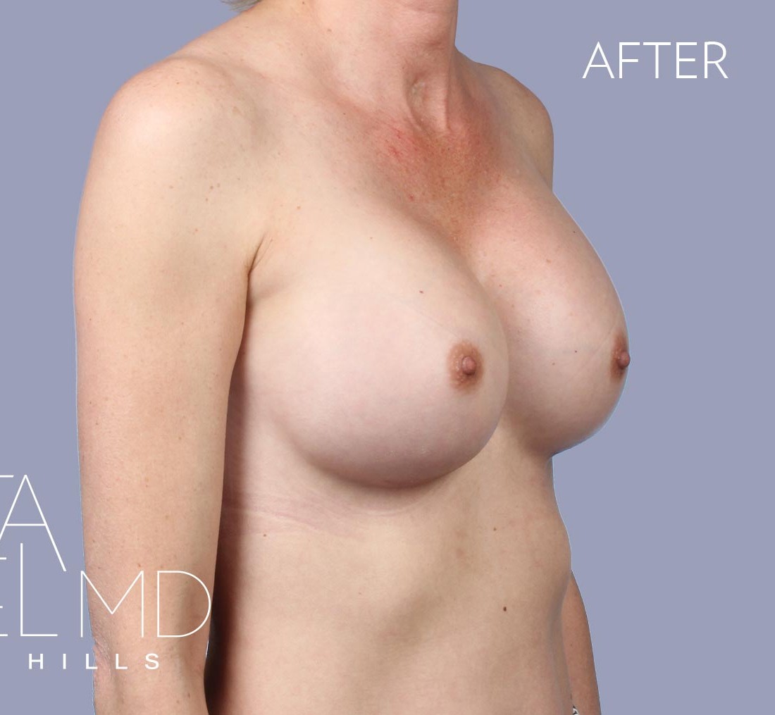 Breast Implant Replacement before and after - after