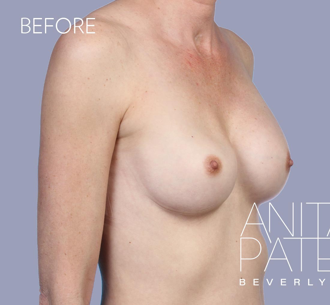 Breast Implant Replacement before and after - before