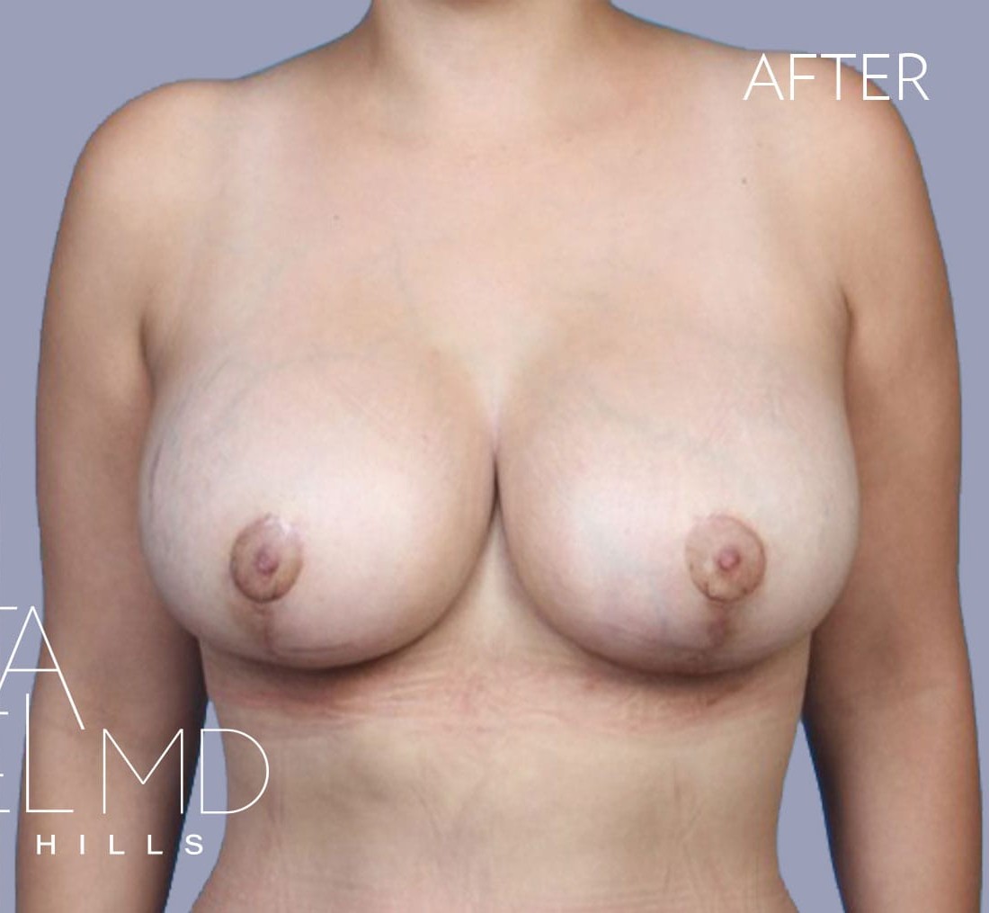 Breast Implant Replacement before and after - after