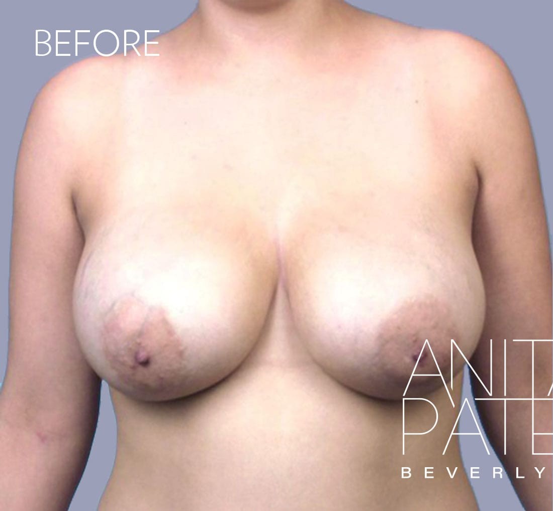Breast Implant Replacement before and after - before