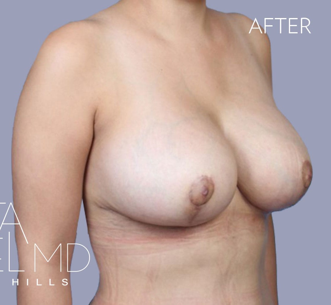 Breast Implant Replacement before and after - after