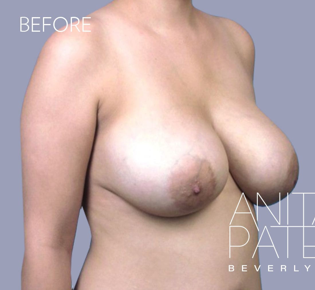 Breast Implant Replacement before and after - before