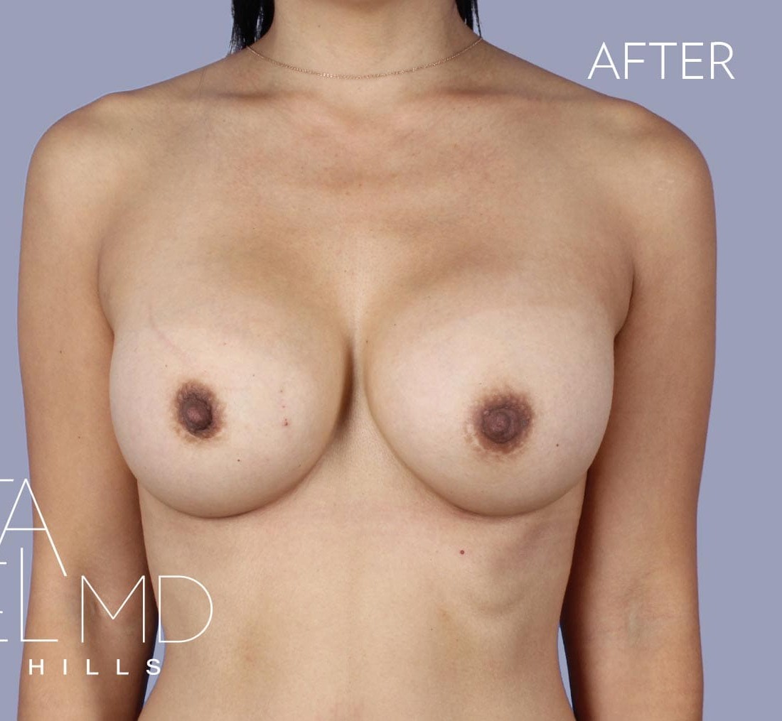 Breast Implant Replacement before and after - after