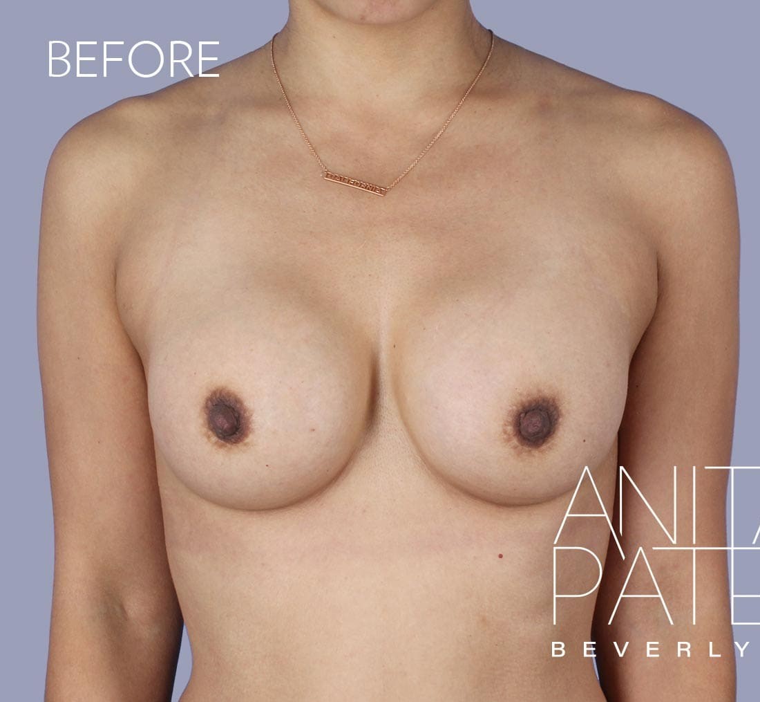 Breast Implant Replacement before and after - before