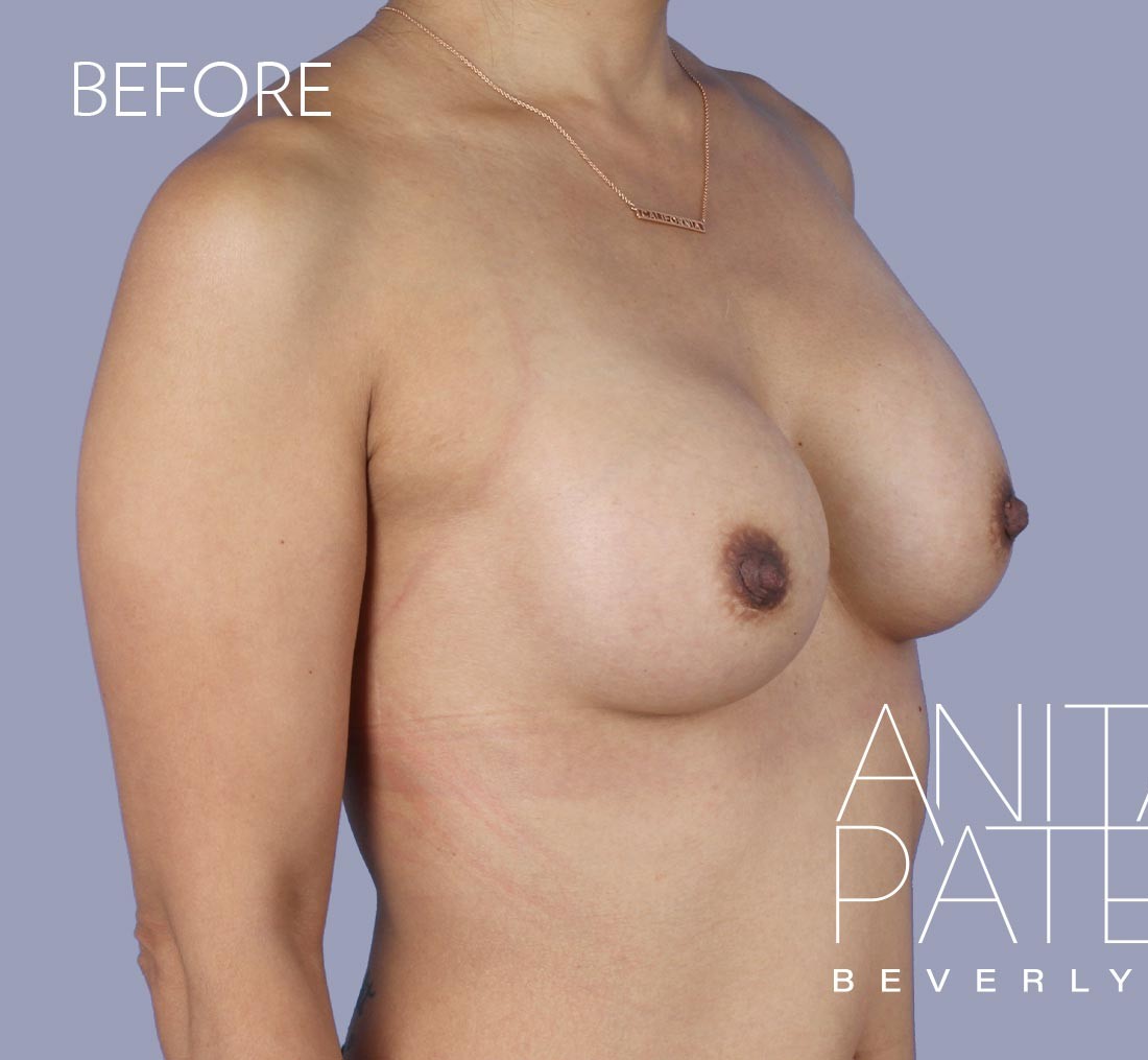Breast Implant Replacement before and after - before