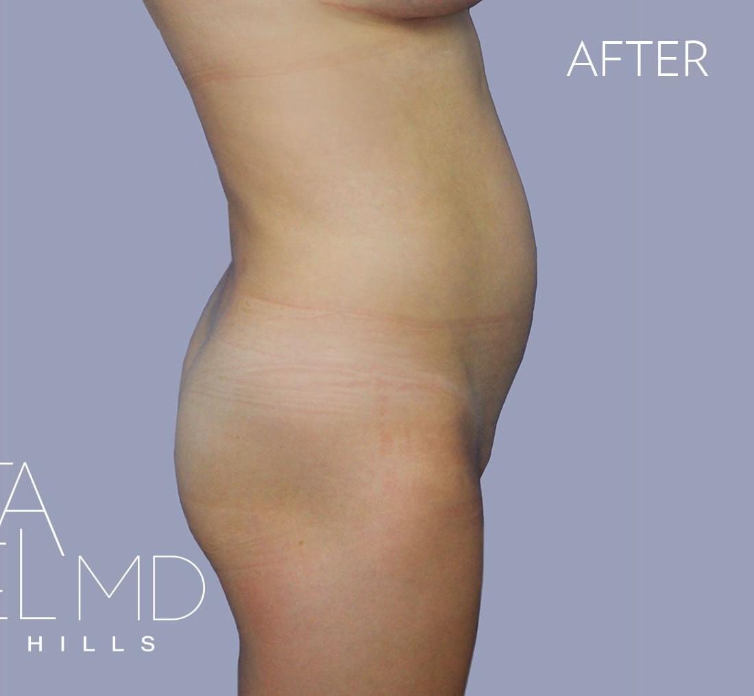 Brazilian Butt Lift before and after - after
