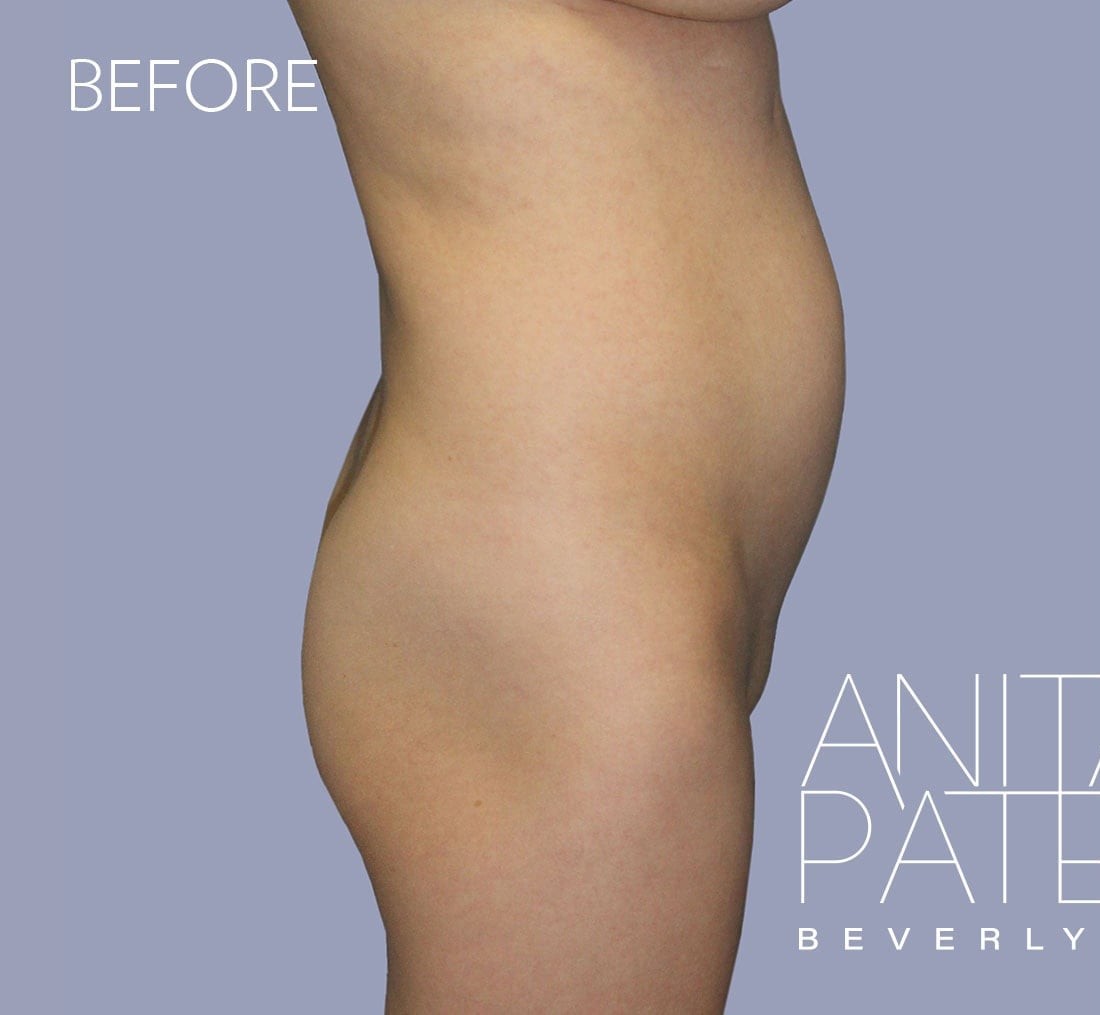 Brazilian Butt Lift before and after - before