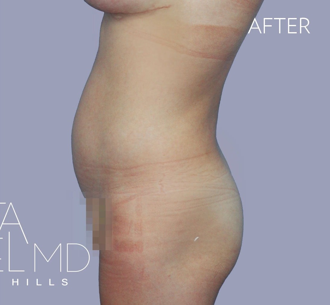 Brazilian Butt Lift before and after - after