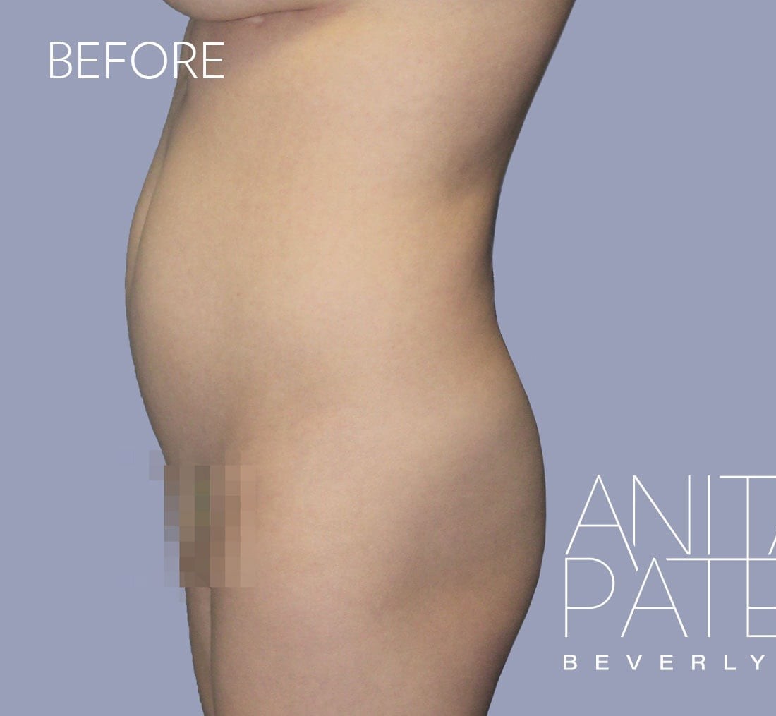 Brazilian Butt Lift before and after - before