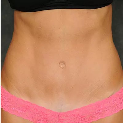 Abdominoplasty before and after - after