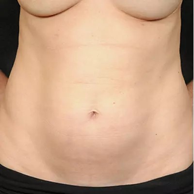 Abdominoplasty before and after - before