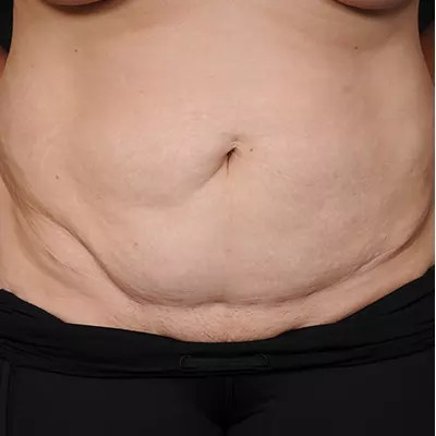 Abdominoplasty before and after - before