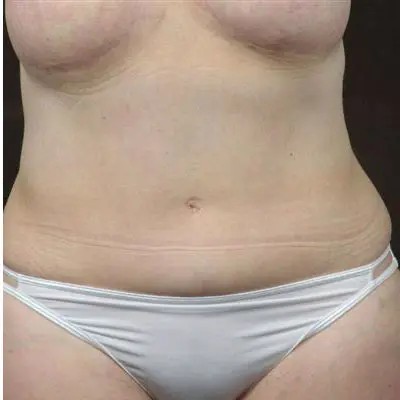 Abdominoplasty before and after - after