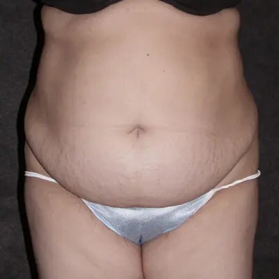Abdominoplasty before and after - before