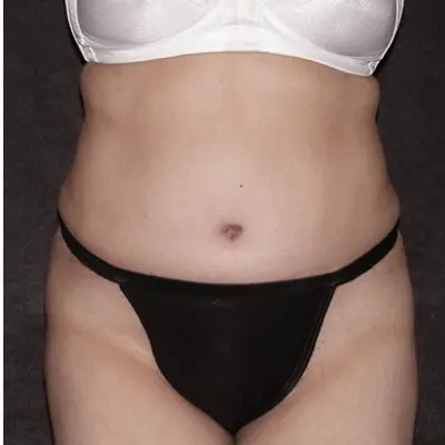 Abdominoplasty before and after - after