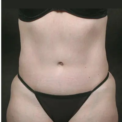 Abdominoplasty before and after - after