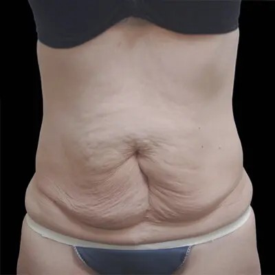 Abdominoplasty before and after - before