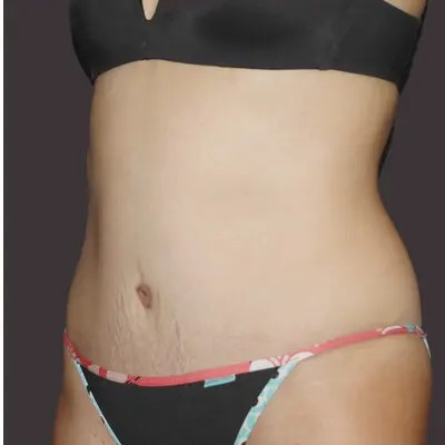 Abdominoplasty before and after - after