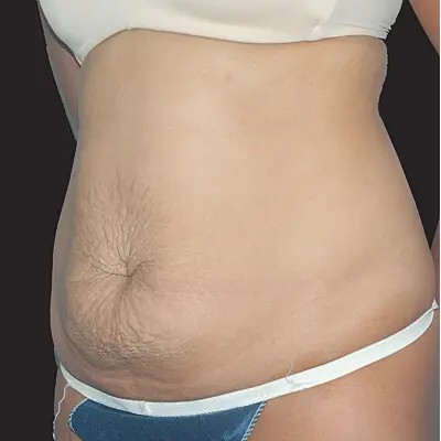 Abdominoplasty before and after - before