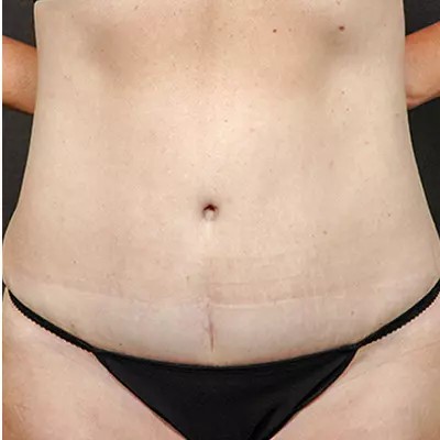 Abdominoplasty before and after - after