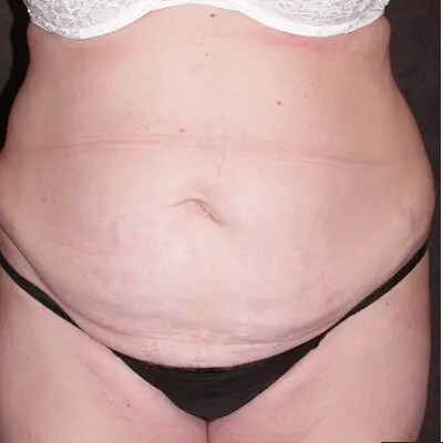 Abdominoplasty before and after - before