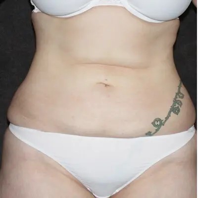 Abdominoplasty before and after - before