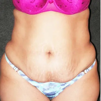 Abdominoplasty before and after - before