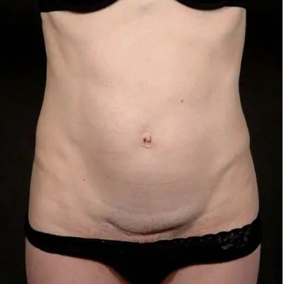 Abdominoplasty before and after - before