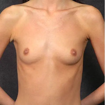 Breast Augmentation before and after - before