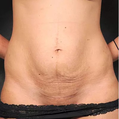 Abdominoplasty before and after - before