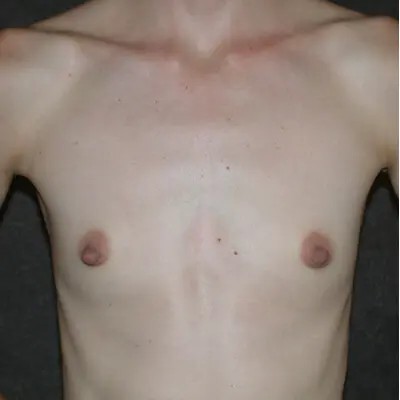 Breast Augmentation before and after - before