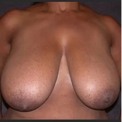 Breast Reduction before and after - before