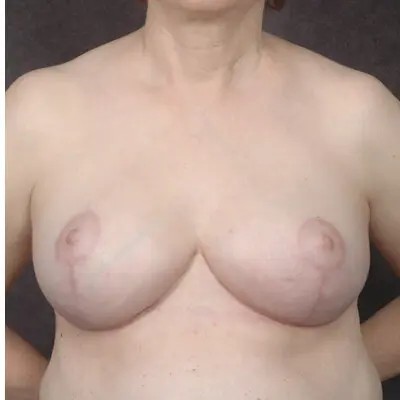 Breast Reduction before and after - after