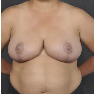 Breast Reduction before and after - after