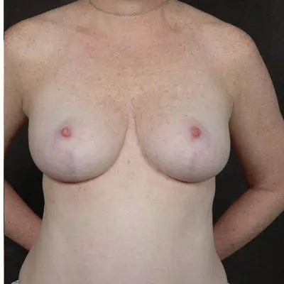 Breast Reduction before and after - after