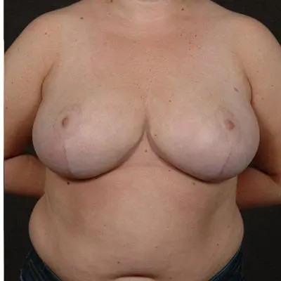 Breast Reduction before and after - after