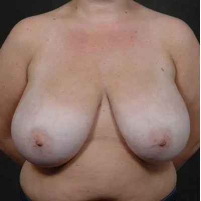 Breast Reduction before and after - before