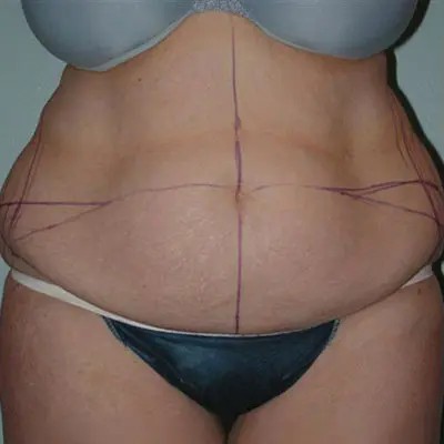 Abdominoplasty before and after - before