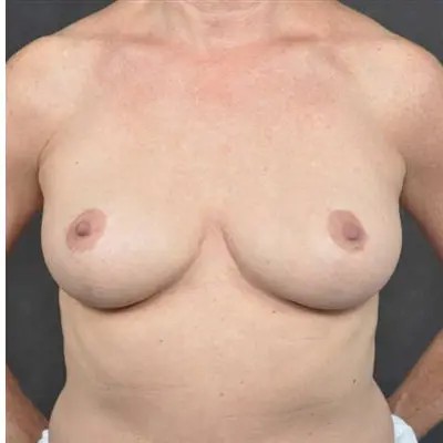 Breast Reduction before and after - after