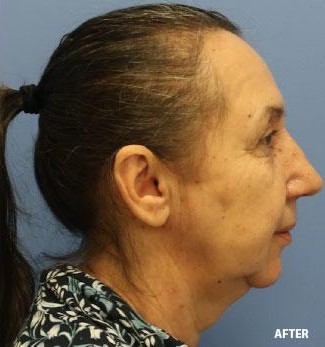 Rhinoplasty before and after - after