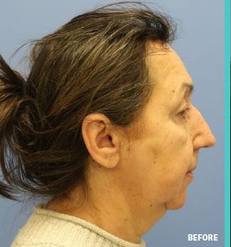 Rhinoplasty before and after - before