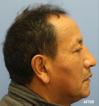Rhinoplasty before and after - after